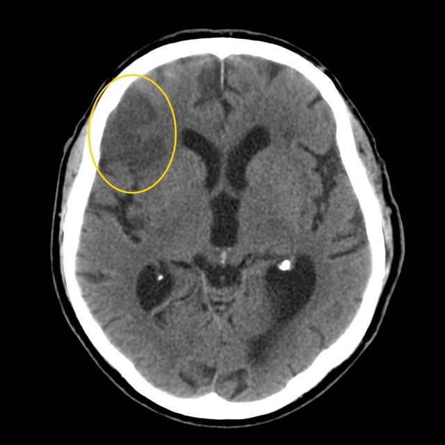 Компьютерная томография головного мозга: что определяет и показывает обследование головы