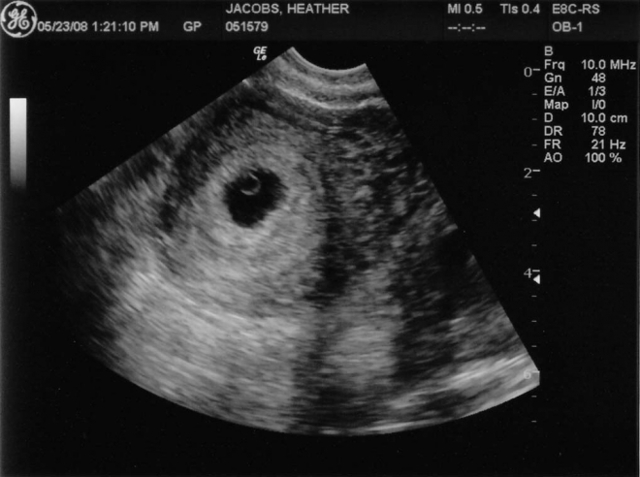 УЗИ на 4 неделе беременности: фото, особенности, техника проведения