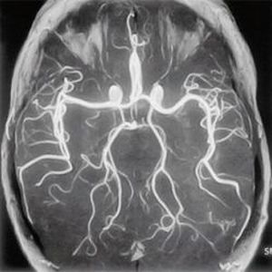 Ангиография сосудов головного мозга и артерий (церебральная), что это такое