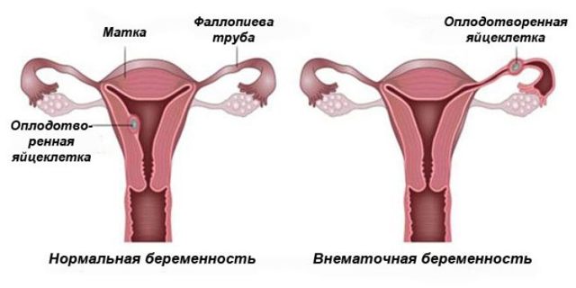 Лапароскопия при внематочной беременности и месячные после нее