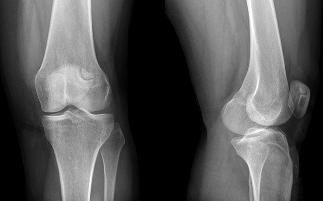 Рентген коленного сустава, что показывает рентгенография колена