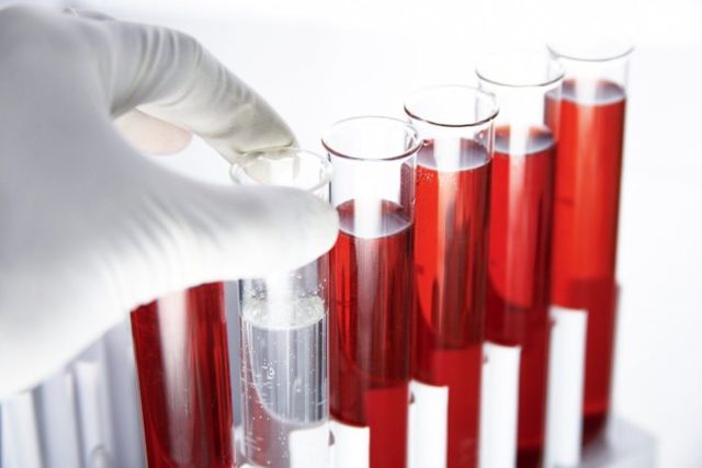 АСЛО в крови: что это такое, почему бывает повышен в анализе, расшифровка