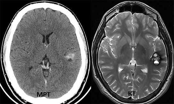 МРТ сосудов головного мозга: что это такое, что показывает, чем отличается