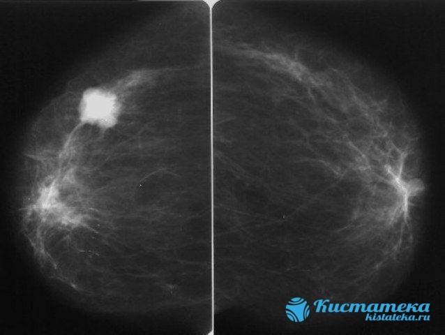 УЗИ молочных желез: что показывает исследование грудной железы, как делают маммографию груди