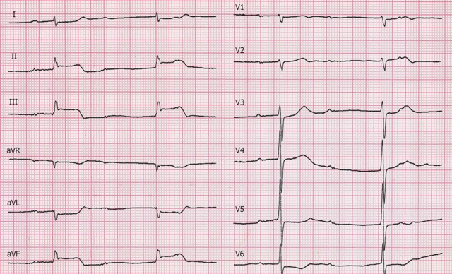 ЭКГ при инфаркте миокарда: признаки патологии на кардиограмме, изменения показателей, фото