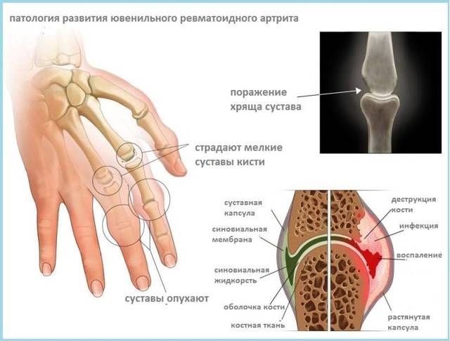МРТ кисти рук и лучезапястного сустава: что показывает, техника проведения