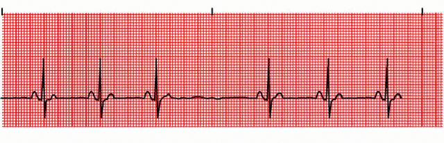 Блокады сердца на ЭКГ: что это такое, внутрижелудочная блокада