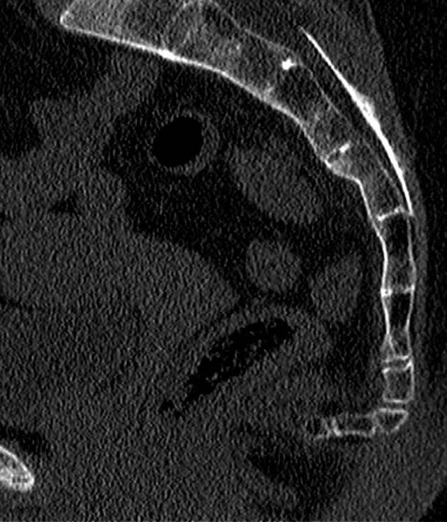 МРТ копчика, что показывает томография крестцово-копчикового отдела позвоночника