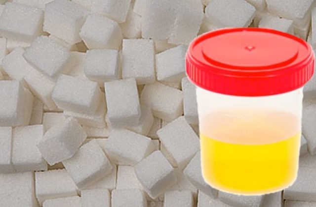 Сахар в моче: что это значит, причины повышенного наличия глюкозы у женщин