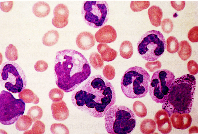 Метамиелоциты в крови: что это значит, причины и лечение повышенного уровня