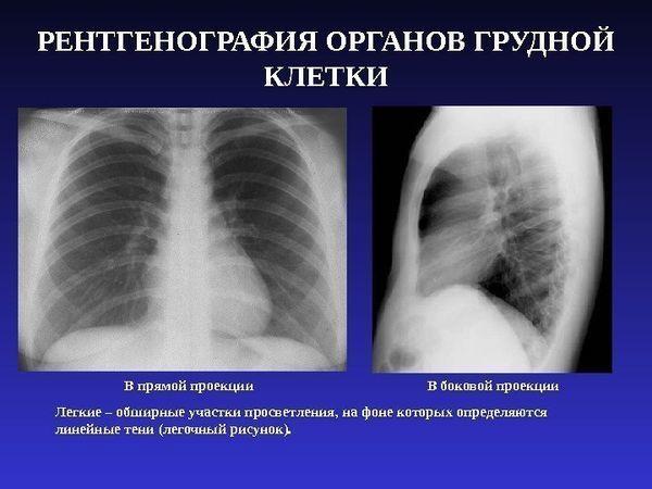 В чем разница между флюорографией и рентгеном легких: чем отличаются, главные отличия
