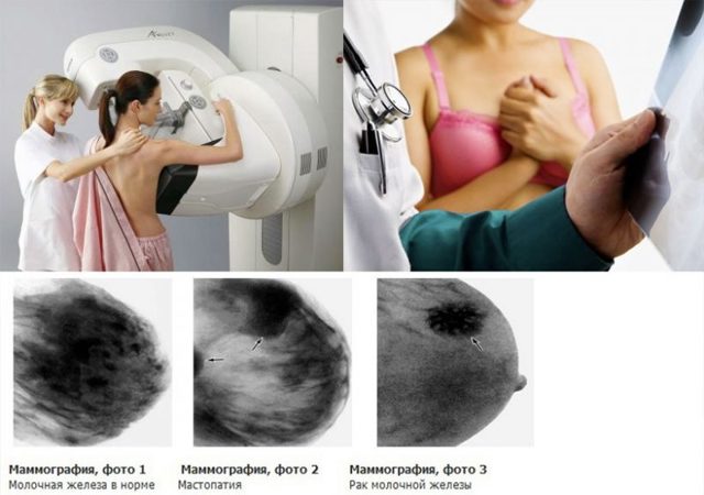 Что лучше УЗИ или маммография, какая диагностика точнее