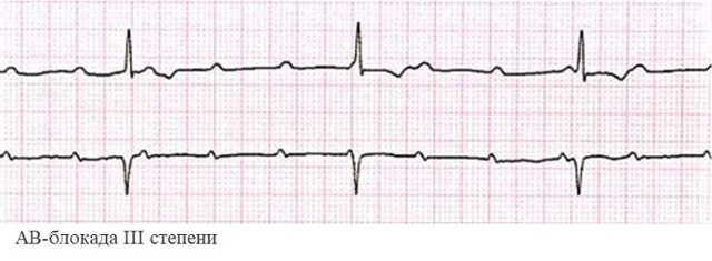 Блокады сердца на ЭКГ: что это такое, внутрижелудочная блокада