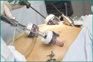 Лапароскопия почки (кисты): подготовка к процедуре, преимущества метода