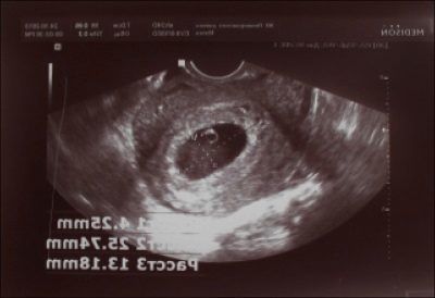 УЗИ на 6 неделе беременности: размеры плода, фото, можно ли делать диагностику