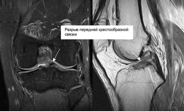 МРТ суставов: что показывает магнитно-резонансная томография сосудов, фото