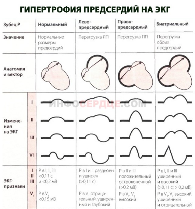 Гипертрофия правого предсердия на ЭКГ, признаки гипертрофии желудочка s типа