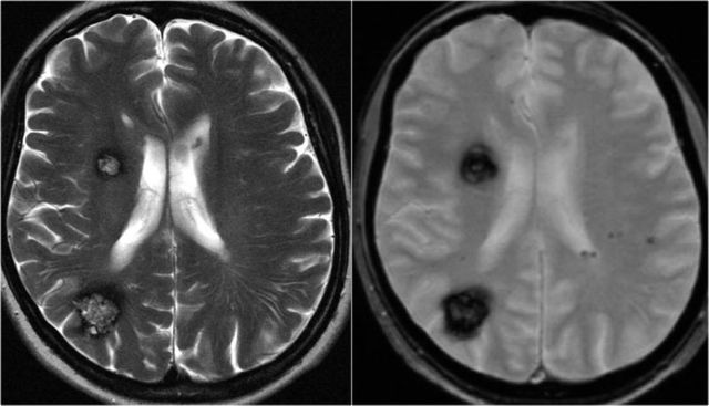 КТ и МРТ головного мозга: чем отличается, что лучше и информативнее