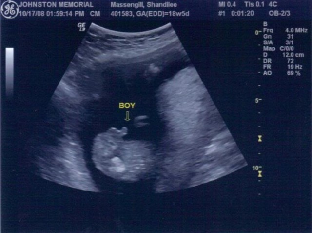 УЗИ на 12 неделе беременности: фото, что смотрят, как делают скрининг плода