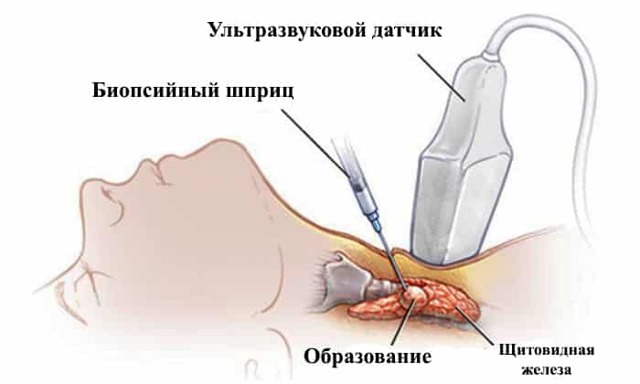 Пункция щитовидной железы под контролем УЗИ (пункционная биопсия узла)