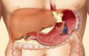Как проверить желудок без гастроскопии: обследование, как определить кислотность