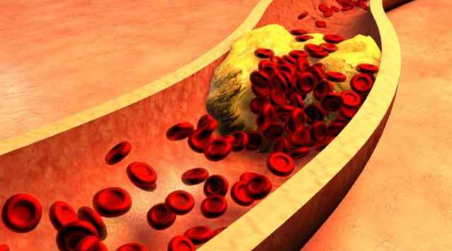 Высокий холестерин в крови у женщин: причины и симптомы повышенного уровня, чем понизить