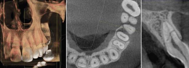 Конусно-лучевая компьютерная томография челюстно-лицевой области в стоматологии