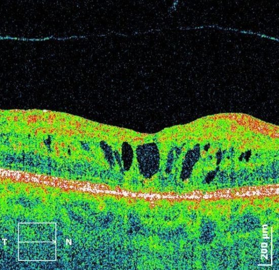 Оптическая когерентная томография глаза (сетчатки, слизистой), что это такое