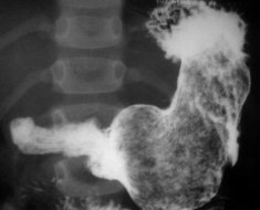 Рентген желудка и кишечника с барием: что показывает, подготовка, последствия, отзывы