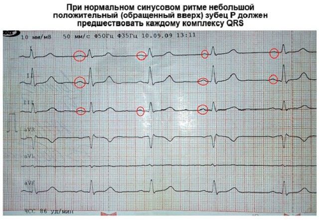 ЭКГ: что это такое, описание кардиограммы сердца, показания, подготовка к диагностике