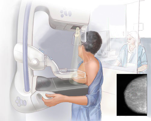 Маммография молочных желез: что это такое, как делается, что показывает, отзывы