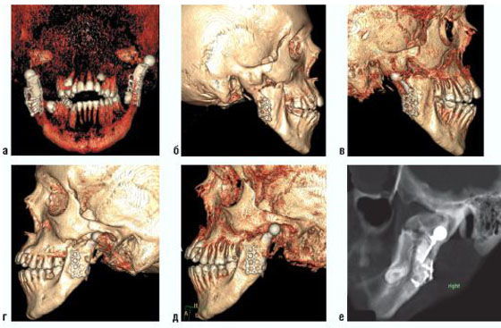Компьютерная томография челюсти (верхней или нижней)