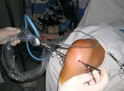 Артроскопия суставов: что это такое, отзывы о лечебно-диагностической операции