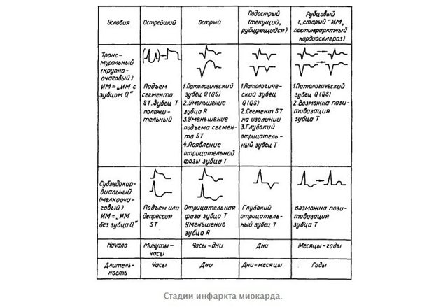ЭКГ при инфаркте миокарда: признаки патологии на кардиограмме, изменения показателей, фото