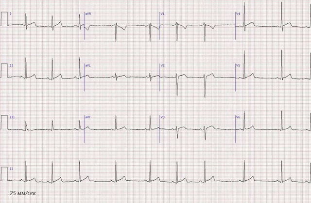 ЭКГ: что это такое, описание кардиограммы сердца, показания, подготовка к диагностике