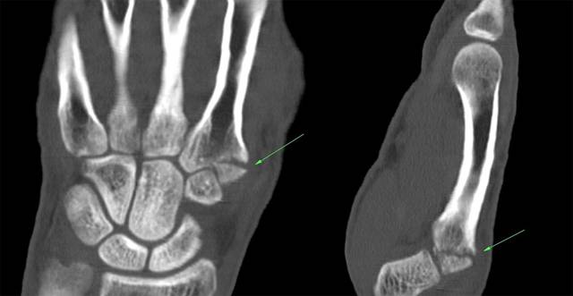 МРТ кисти рук и лучезапястного сустава: что показывает, техника проведения