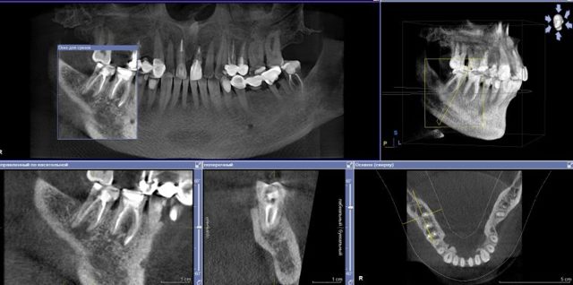 3Д рентген зубов и в чем преимущества 3d диагностики