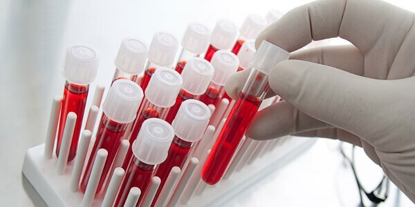 Анализ крови на hcv anti total: что это такое, расшифровка, подготовка к диагностике