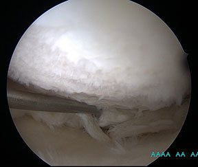Артроскопия мениска коленного сустава: показания и проведение