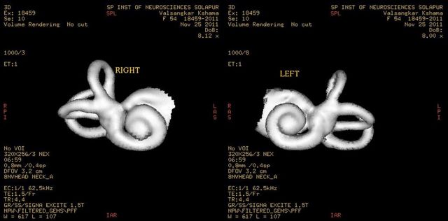 МРТ внутреннего уха: что показывает, показания и ограничения, подготовка
