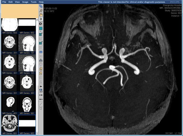 Ангиография сосудов головного мозга и артерий (церебральная), что это такое