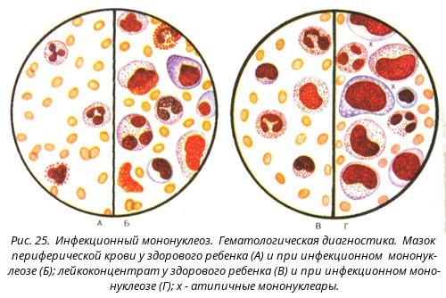 Атипичные мононуклеары в крови у ребенка или взрослого: норма в общем анализе, что значат