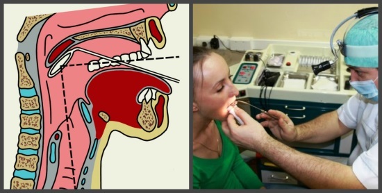 Эндоскопия носоглотки: отзывы, что это такое, показания к эндоскопическому исследованию носа