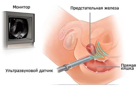 Подготовка к УЗИ предстательной железы и мочевого пузыря, как подготовиться