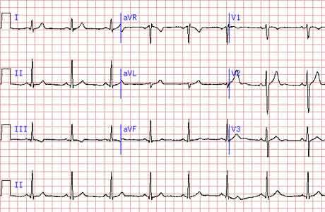 Расшифровка ЭКГ у взрослых: норма кардиограммы сердца, таблица показателей, фото
