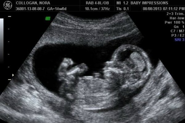 Пол ребенка на УЗИ при беременности в 13 недель: фото, как определить