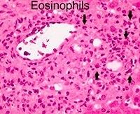 Повышены эозинофилы в крови у взрослого: причины повышения, что это значит