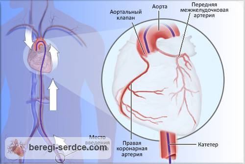 Ангиография сосудов сердца: что это такое, особенности проведения